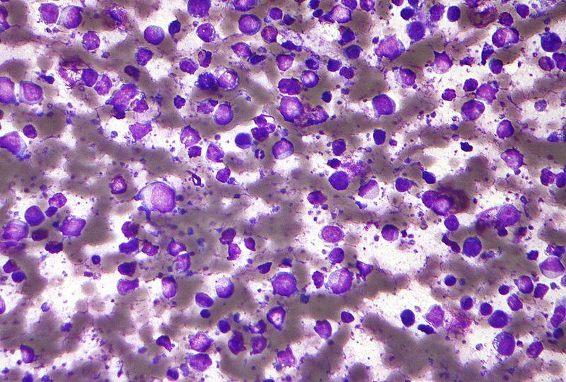 method/9/800px-Diffuse_large_B_cell_lymphoma_-_cytology_low_mag.jpg